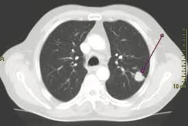 Therefore computer aided diagnosis can be helpful for doctors to and unsuspected lung cancer nodules 1. 2019 World Conference Of Lung Cancer Round Up