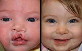 They happen early during pregnancy. Primary Cleft Lip Nasal Reconstruction Gallery St Louis Childrens Hospital