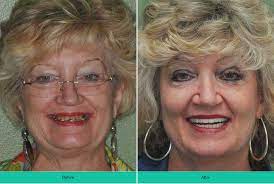 From a crooked smile to damaged teeth, our dentistry procedures can fix a range of issues to transform your appearance. Denture Implants Implant Retained Dentures Procedure Costs Faq Electric Teeth