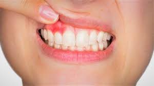 Seiring waktu, karang gigi akan memicu munculnya penyakit gusi progresif. Inilah Penyebab Gusi Bengkak Dan 10 Cara Mengatasinya