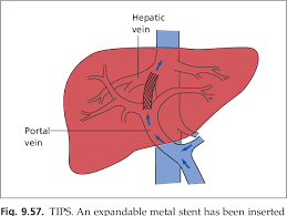 Go to portal artery page via official link below. The Hepatic Artery Portal Venous System And Portal Hypertension The Hepatic Veins And Liver In Circulatory Failure Semantic Scholar