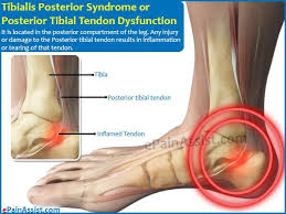 Tibialis Posterior Syndrome Jpg 600 450 Posterior Tibial Tendonitis Leg Injury Tendonitis Symptoms