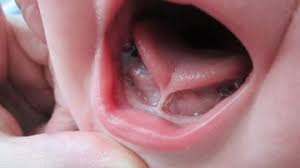 Frenillo Lingual Clinica Dental Everest