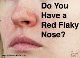 Do You Have A Red Flaky Nose Dry Nose Skin Dry Flakey Skin Seborrheic Dermatitis