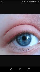 Die augen am morgen nicht jucken tun, aber geschwollen und die schwellung abklingt am abend und beginnen zu jucken. Augenlid Ist Geschwollen Augen Schwellung