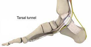 How To Self Treat Tarsal Tunnel Syndrome Marathon Training Academy