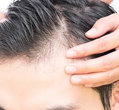 Hair loss is a common dermatological problem that has been estimated to affect between 0.2 and 2% of gurkan yardimci (may 3rd 2017). Scalp Health Dr Sunny Medical Center Sharjah