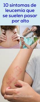 Este hecho, junto a que se. 10 Sintomas De Leucemia Que Se Suelen Pasar Por Alto El Reportero Honduras