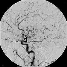 This test is also known by other names, including cerebral angiography and cerebral arteriogram. Digital Subtraction Angiography Wikipedia