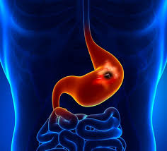 As the cancer cells multiply: 6 Warning Signs Of Stomach Cancer Health Katalay Net