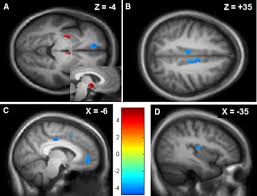 Complex Regional Pain Syndrome Is Associated With Structural Abnormalities In Pain Related Regions Of The Human Brain The Journal Of Pain