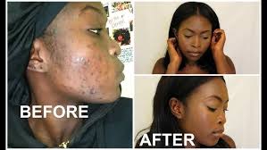 WORTH IT? L'OREAL PURE-CLAY MASK