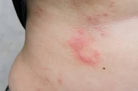 Also Known As Hives Is Caused By An Allergic Reaction