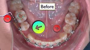 Unfortunately, many options for fixing gap teeth are invasive and extremely expensive. Why Are My Teeth Moving Apart With Braces