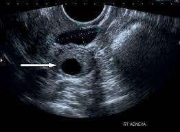 Malignant ovarian cysts are only seen in rare cases, with the benign being the most common of them all. Sonographic Assessment Of Ovarian Cysts And Masses Chapter 8 Gynaecological Ultrasound Scanning