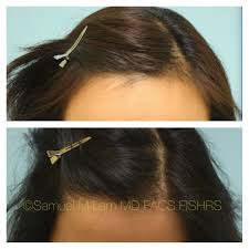 Hair loss isn't just a guy thing. This 33 Year Old Asian Female Is Shown Before And 10 Months After A Female Hairline Lowering To Improv Hair Transplant Women Frontal Hairstyles Hair Transplant