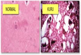 Kuru (You get it from eating brains!) | Neurology Update