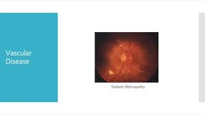 Image result for Acute Vision Loss