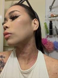 How to take care of eczema and skin after having a baby?