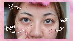 Expect your skin to begin peeling around day 3 or 4 after your laser skin resurfacing treatment. Results Of Acne Laser Treatment Before After Youtube
