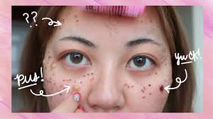 results of acne laser treatment before