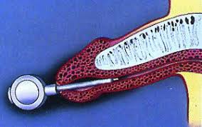 Image result for Intraurethral Alprostadil