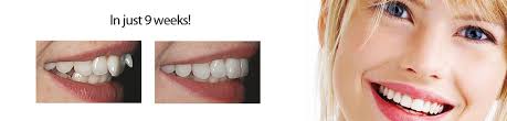 Inman aligners offer an accelerated orthodontic solution for those who don't wish to go down the route of full braces. Inman Aligner