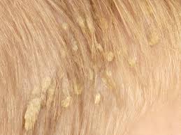 Thick, adherent scale extending up the hair shaft (pityriasis amiantacea). Pityriasis Amiantacea