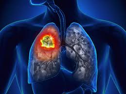 In stage iv, the cancer has metastasized, or spread, beyond the. Fda Approves Atezolizumab For Extensive Stage Small Cell Lung Cancer Cls Health