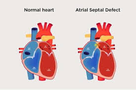 Image result for Atrial Septal Defect