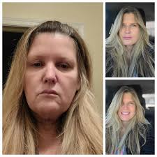 Face-lift & Neck-lift Support Group