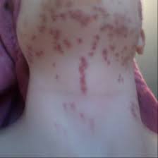 Maybe you would like to learn more about one of these? M2 Bed Bug Treatment M2 Bed Bugs Llc