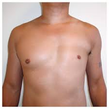 Several techniques are used to correct the chest deformity. Poland S Syndrome Case 2 Drsalibian Com
