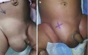 Image result for Inguinal hernia child
