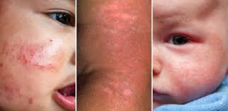 People with brown skin have more chances of having dark spots on face, while people with light skin turmeric is widely used to whiten skin, so it will help you get rid of black scars on face. Baby Eczema Atopic Dermatitis On Your Infant Symptoms Treatment