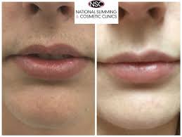 With this growth cycle, you may notice periods of increased and decreased hair growth throughout your treatment. 7 Laser Hair Removal Before And After Ideas Laser Hair Removal Hair Removal Laser