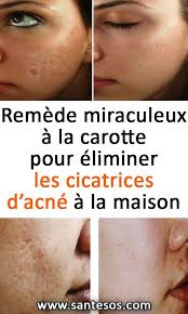 Remede Miraculeux A La Carotte Pour Eliminer Les Cicatrices D Acne A La Maison Remede Carotte Remedes Cicatrices Acne Remedesmaison Skin Care Skin Care