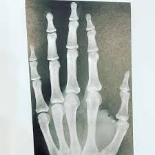 Image result for Hand Growth Plates