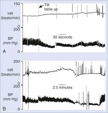 Image result for Head-Up Tilt-Table Testing