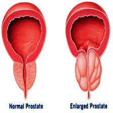 Finding it difficult to start peeing. Home Remedies For Enlarged Prostate Natural Treatment