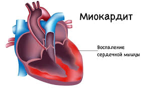 Cauza stenocardiei este ischemia muschiului cardiac. Durere In InimÄ NaturÄ Cauze Tratament Dureri Dureroase In InimÄ Cauze Èi Tratament Posibile Boli