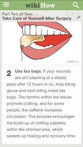 Pin On Dry Socket Tooth Aches Lost Fillings