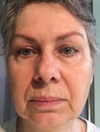 Face Yoga Method Results