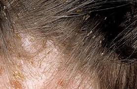 Lice can infect anyone of any age or gender regardless of how clean or dirty the person keeps their hair; What Do Lice Eggs Look Like On Hair Lice Infestation Head Louse Lice Removal