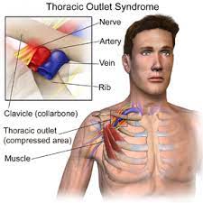 Thoracic Outlet Syndrome Wikipedia