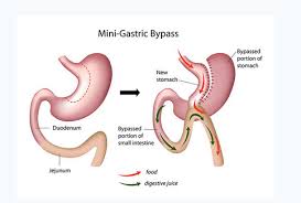 Mini Gastric Bypass Surgery Services In Somajiguda
