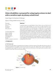 Exotropia In The Left Eye The Light Reflex Is Central In The Right Eye Download Scientific Diagram