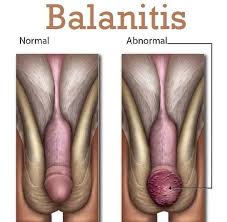 Image result for balanoposthitis