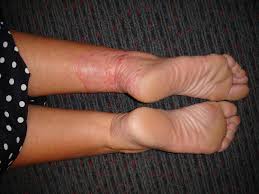 Er besteht im wesentlichen aus dem oberschenkelknochen. Ringelflechte Tinea Corporis Deximed