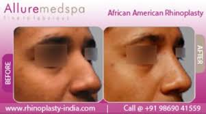 African American Rhinoplasty Is One Of The Best Cosmetic Surgery For African American Patients To Reshaping Th Rhinoplasty Surgery Rhinoplasty Cost Rhinoplasty